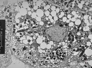 M,15y. | steatosis M,15y. | steatosis